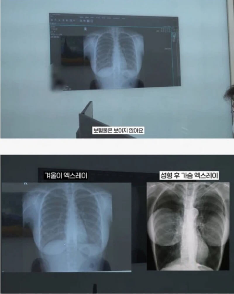 Cặp đôi nữ streamer gợi cảm Winter cô nàng chiêu trò từng đi chụp X quang ngực