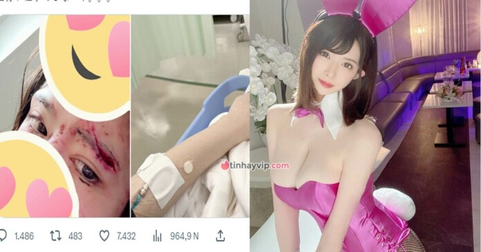 honoka-tsuji-gap-tai-nan-anh-huong-den-khuon-mat-0 Honoka Tsuji gặp tai nạn ảnh hưởng lớn đến khuôn mặt