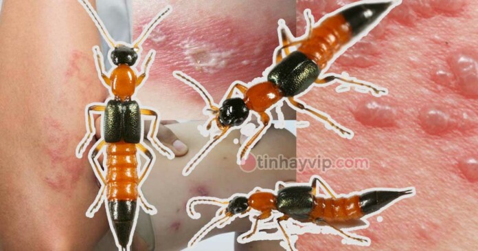 hinh-anh-bi-kien-ba-khoang-can-dau-hieu-cach-tri-0 Hình ảnh bị kiến ba khoang cắn: dấu hiệu và cách điều trị