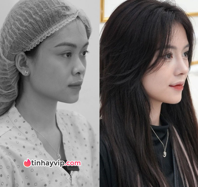 Idol TikTok trước và sau khi phẫu thuật thẩm mỹ
