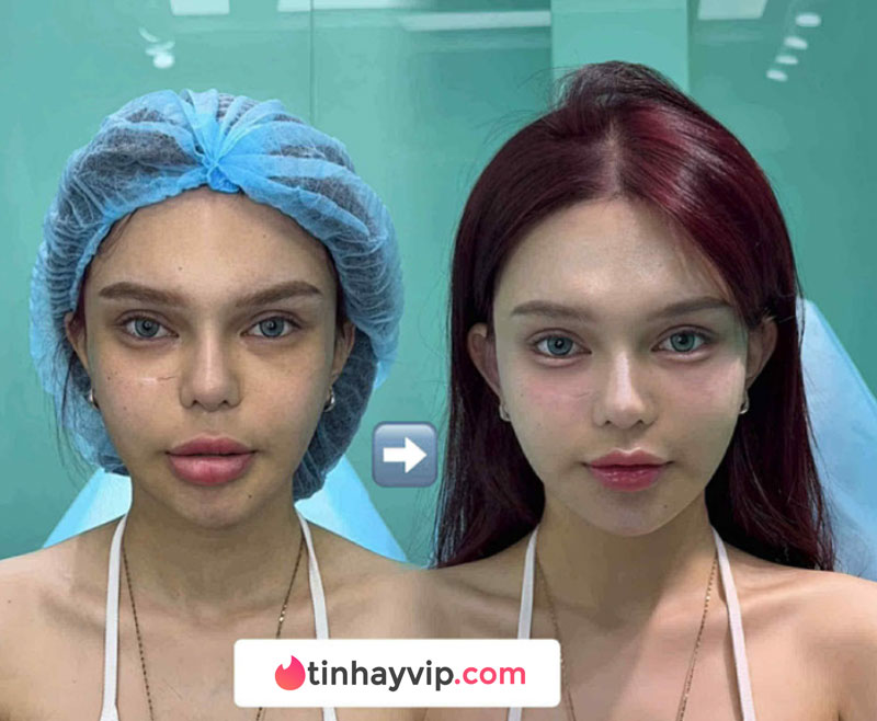Idol TikTok trước và sau khi phẫu thuật thẩm mỹ
