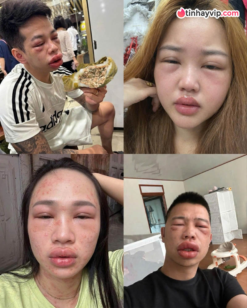 Bánh trứng kiến gây sốt MXH khiến nhiều người nhập viện vì sốc phản vệ